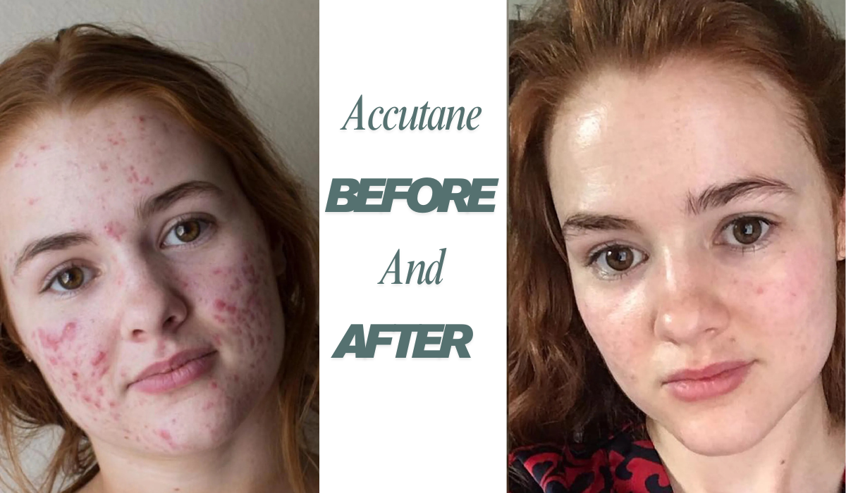 accutane before and after